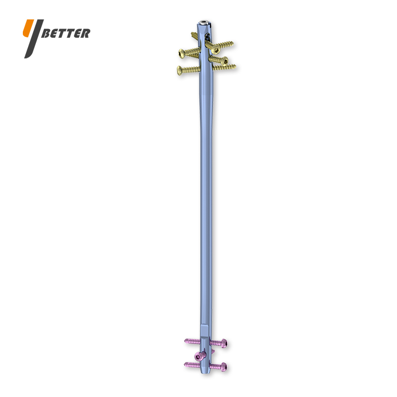 鎖定型脛骨髓內釘