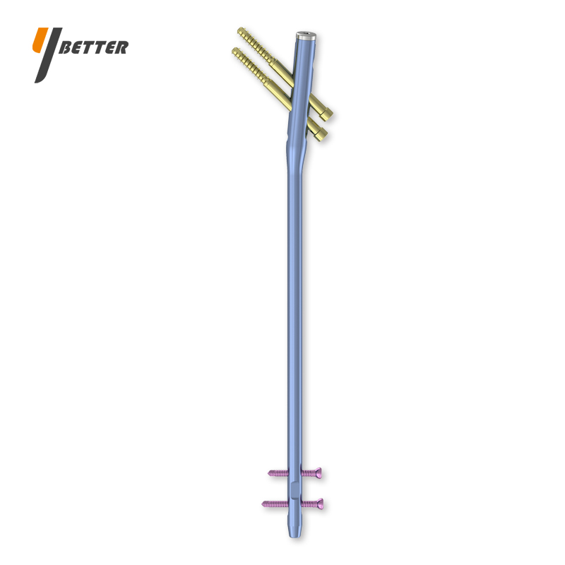 股骨帶鎖髓內釘（3合1）