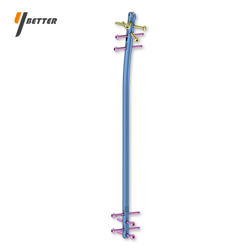 專家級脛骨帶鎖髓內釘