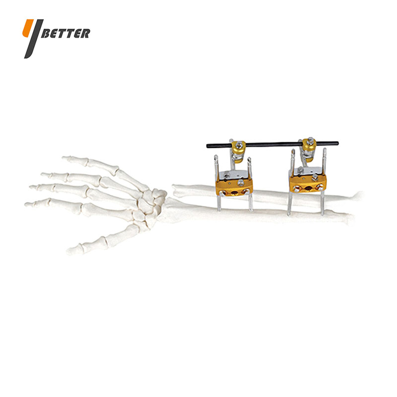 尺橈骨型固定支架